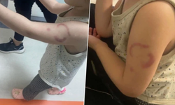 Kreşte üç yaşındaki çocuğu ısıran bakıcı tutuklandı