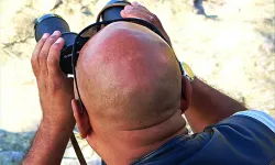 Yeni kellik ilacı: Yüzde 539 oranında saç artışı