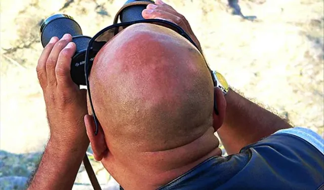 Yeni kellik ilacı: Yüzde 539 oranında saç artışı