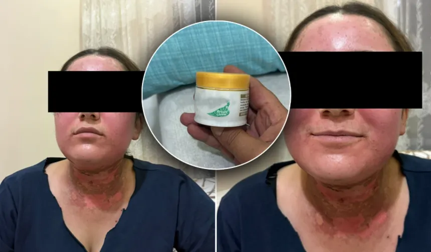 Van’da sahte krem skandalı: 19 yaşındaki genç kadının yüzü yandı